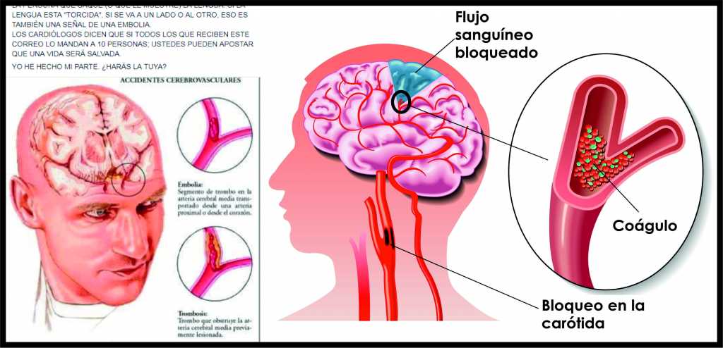 Las Señales De La Embolia O Derrame Cerebral Que Pueden Salvar Una Vida